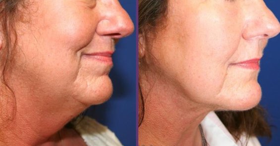How Much Does a Neck Lift Cost in Fort Lauderdale?