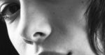 Types of Nose Surgery