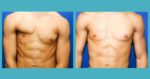 Poland Syndrome - Signs, Symptoms & Surgery | Dr Zoran Potparic