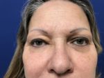 BLEPHAROPLASTY UPPER AND LOWER