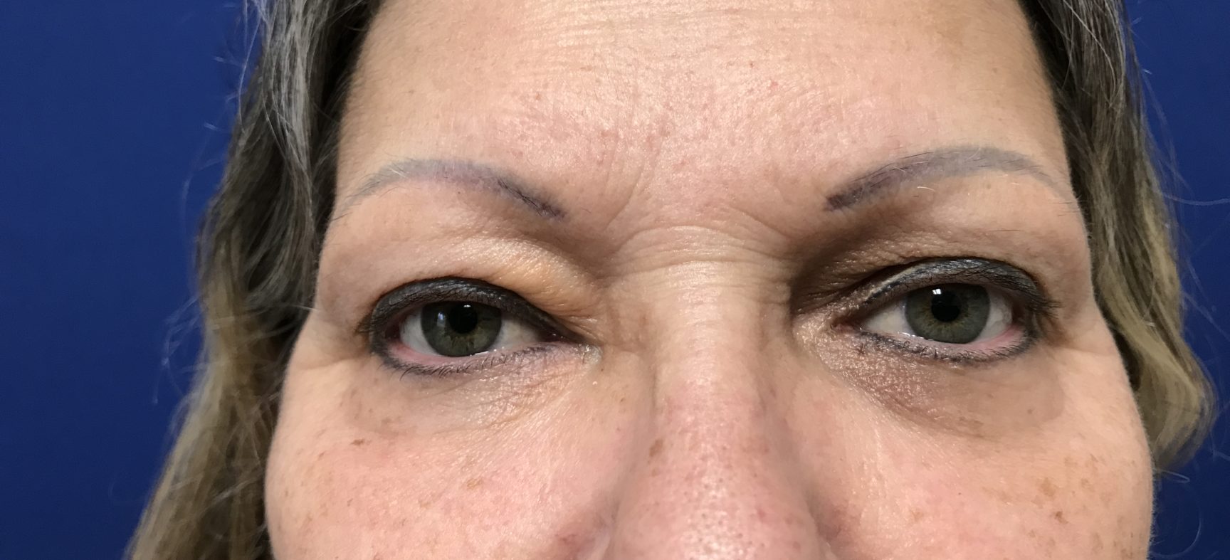 BLEPHAROPLASTY UPPER AND LOWER