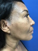 FACE AND NECK LIFT