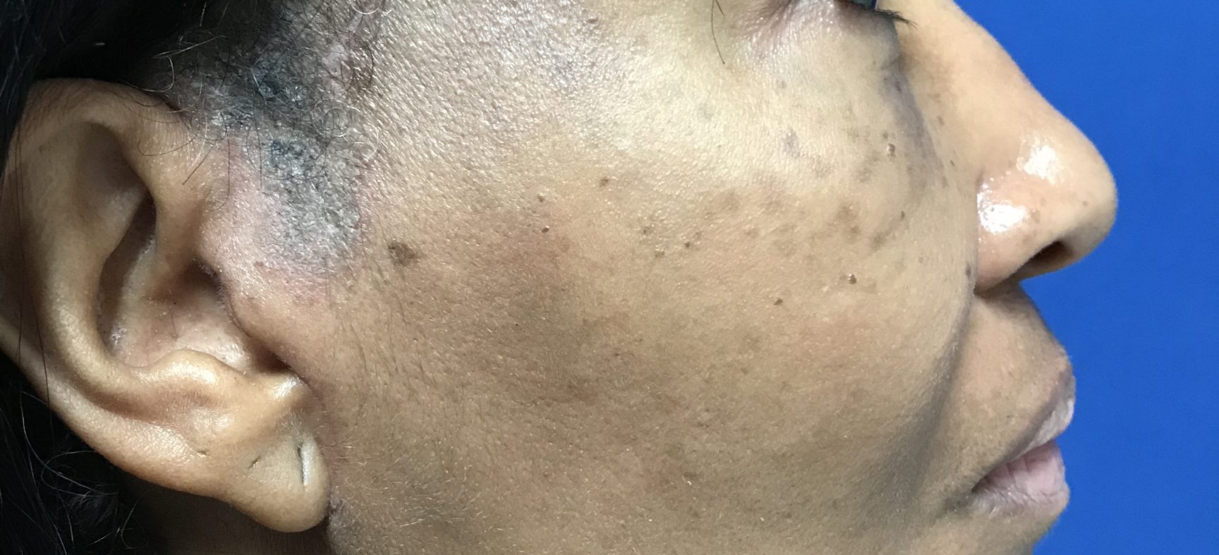 FACE AND NECK LIFT
