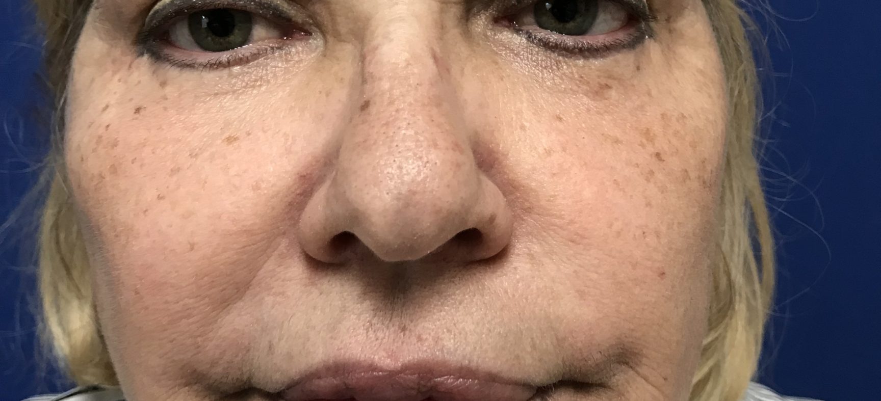 FACE AND NECK LIFT