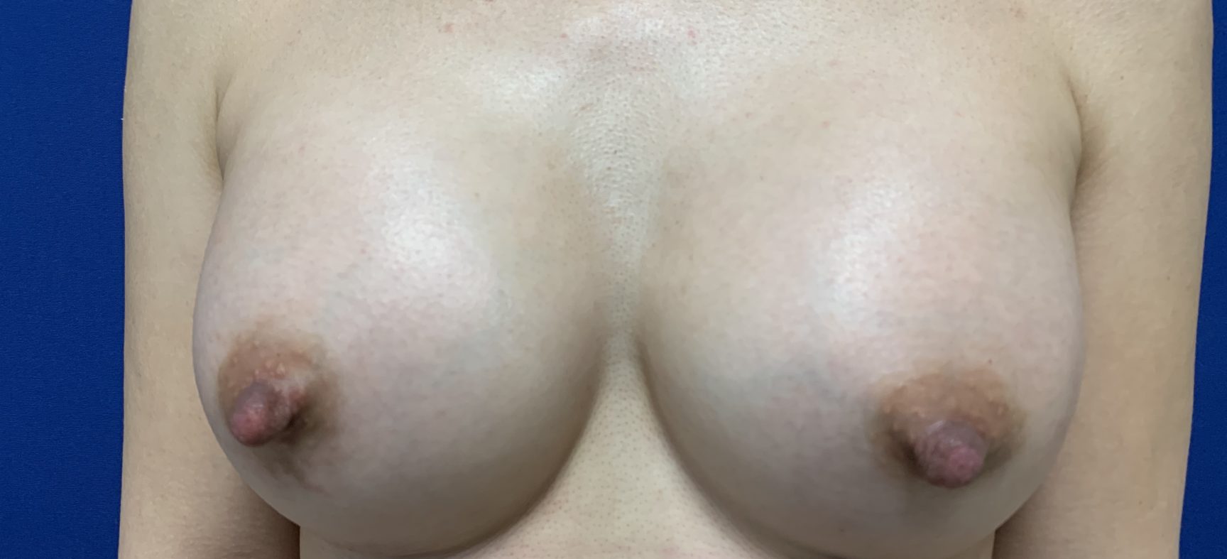 BREAST AUGMENTATION