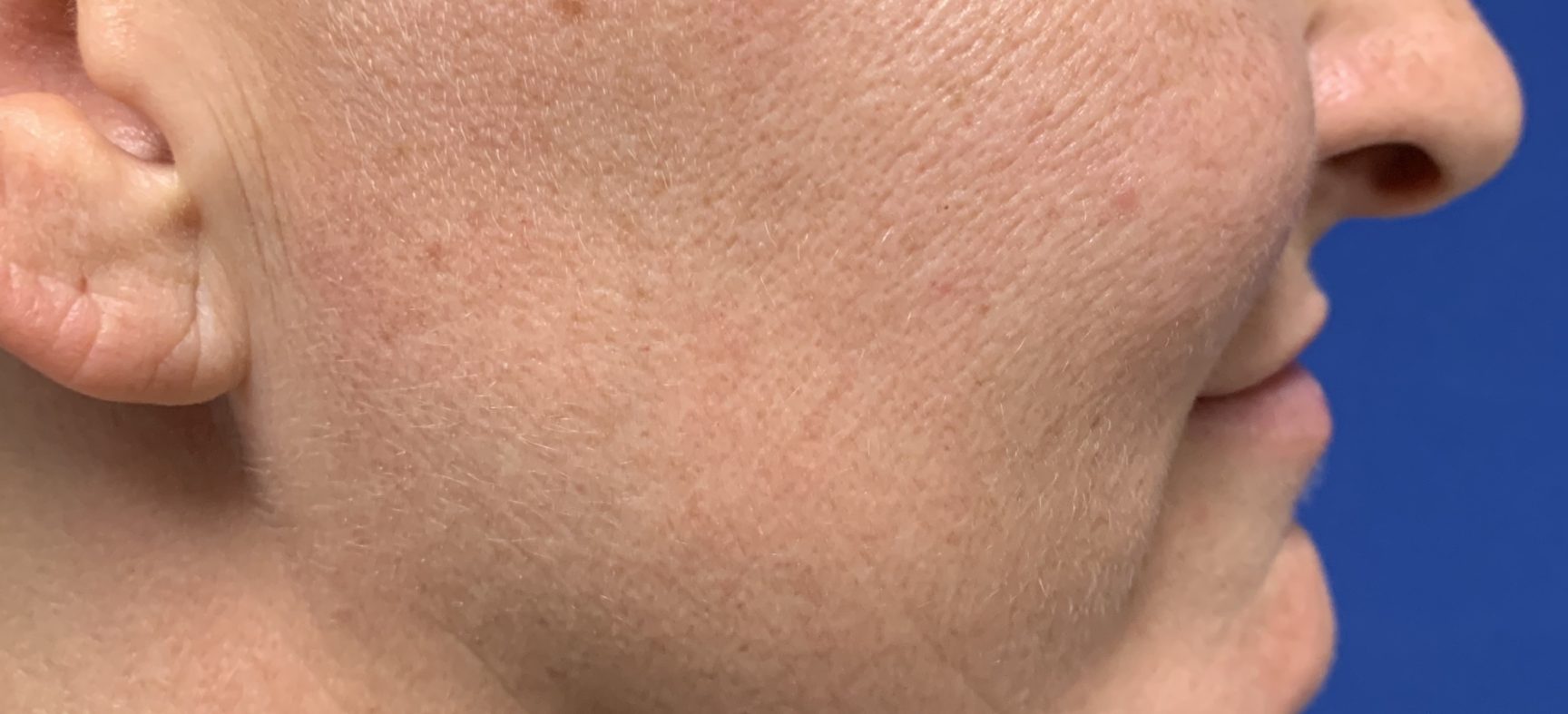NECK LIFT