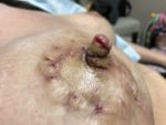 NIPPLE-AREOLA SURGERY