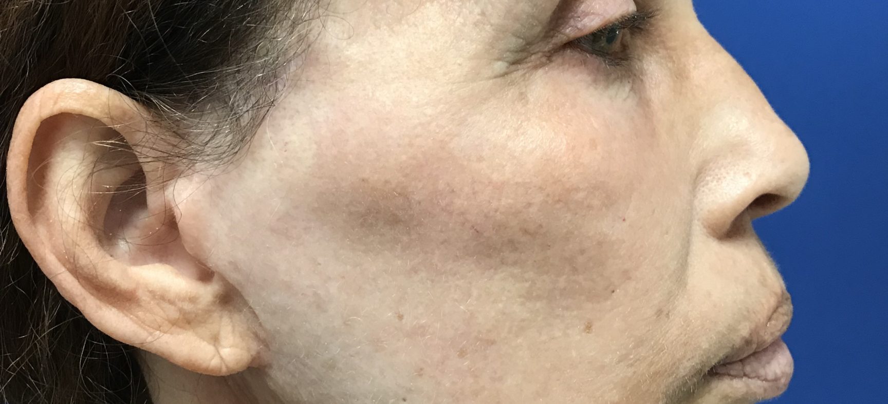 FACE AND NECK LIFT WITH FAT GRAFTS