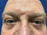 LOWER BLEPHAROPLASTY- TRANSCONJUCTIVAL