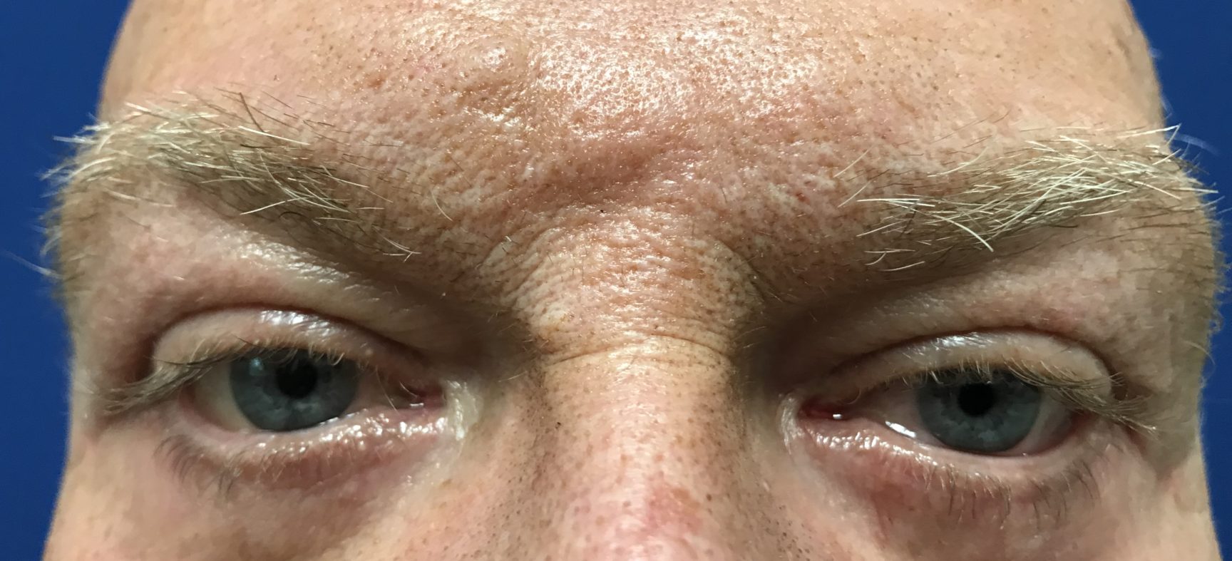 LOWER BLEPHAROPLASTY- TRANSCONJUCTIVAL