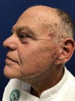 FACE AND NECK LIFT