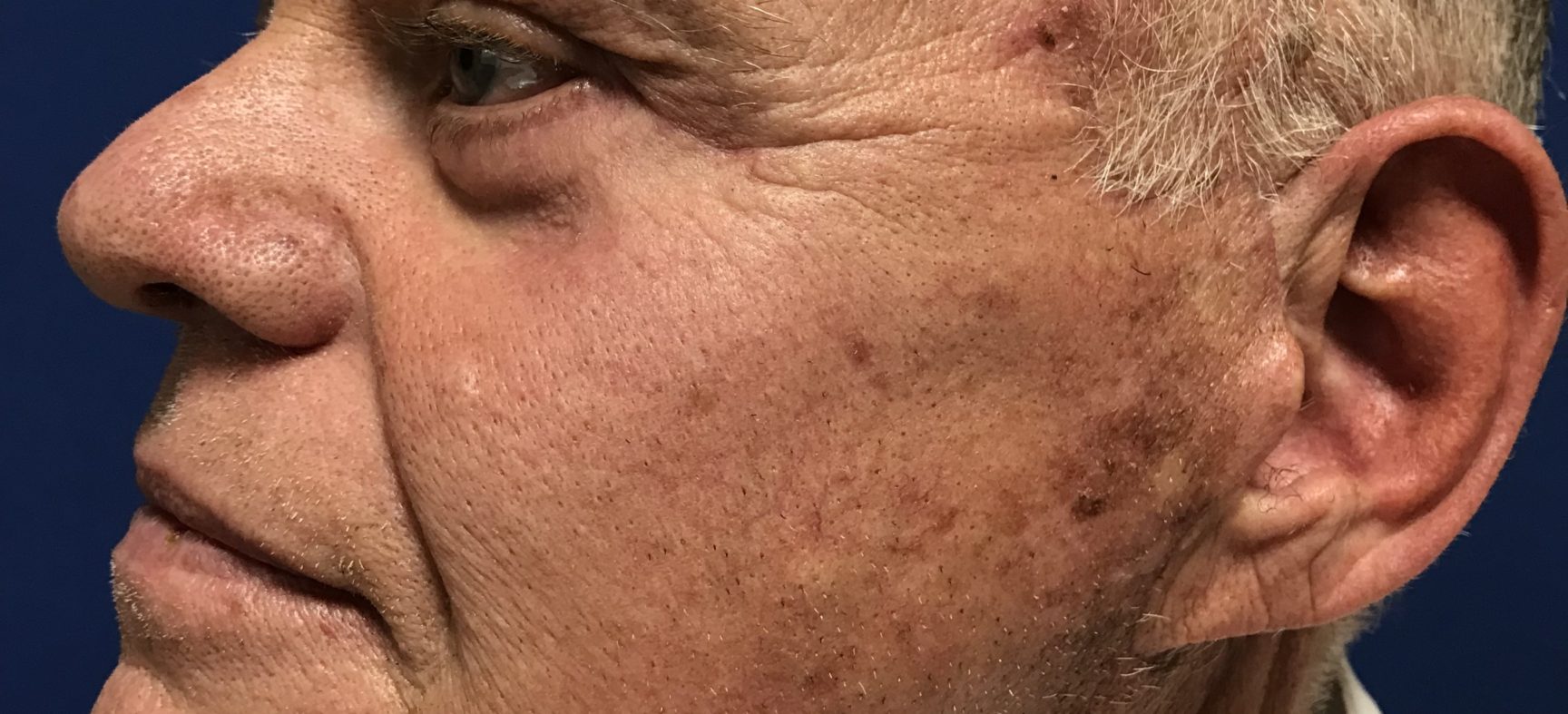 FACE AND NECK LIFT