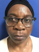 FACE AND NECK LIFT