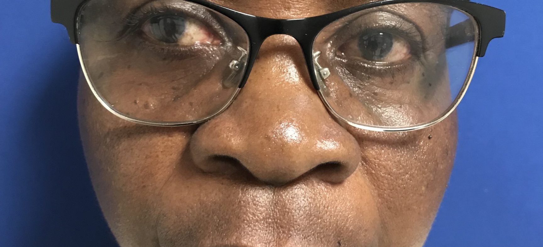 FACE AND NECK LIFT