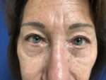 BLEPHAROPLASTY WITH FACIAL FAT GRAFTS