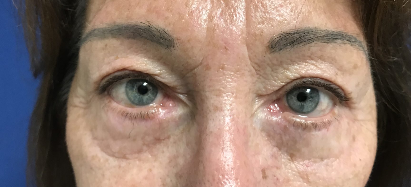 BLEPHAROPLASTY WITH FACIAL FAT GRAFTS