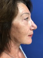FACE AND NECK LIFT