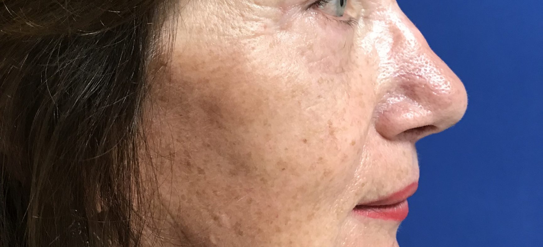 FACE AND NECK LIFT