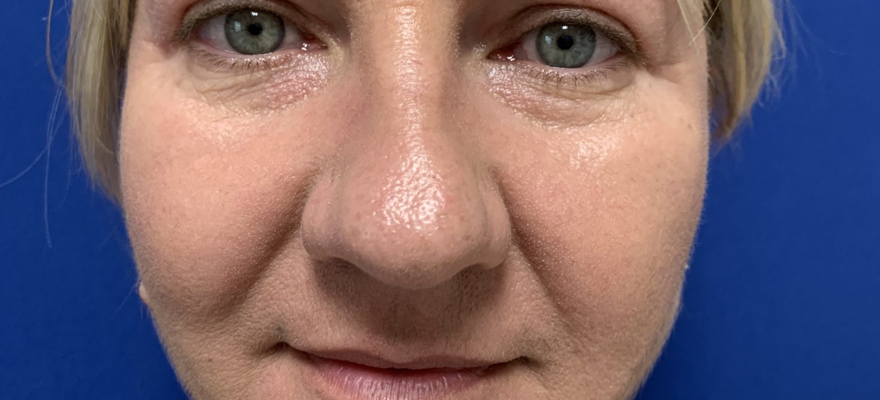 FACE AND NECK LIFT