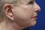 FACE AND NECK LIFT REVISION- PIXIE EARLOBES