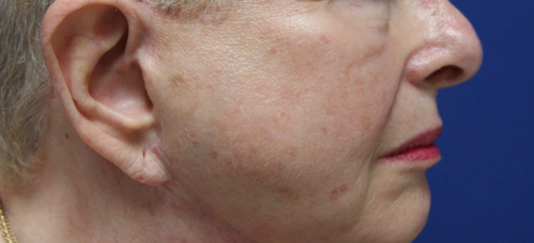 FACE AND NECK LIFT REVISION- PIXIE EARLOBES