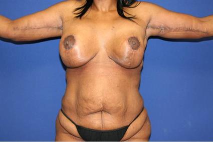 ARM LIFT CASE 92
