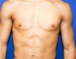 Body contouring- Poland Syndrom correction with muscle transfer