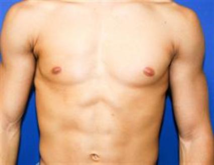 Body contouring- Poland Syndrom correction with muscle transfer