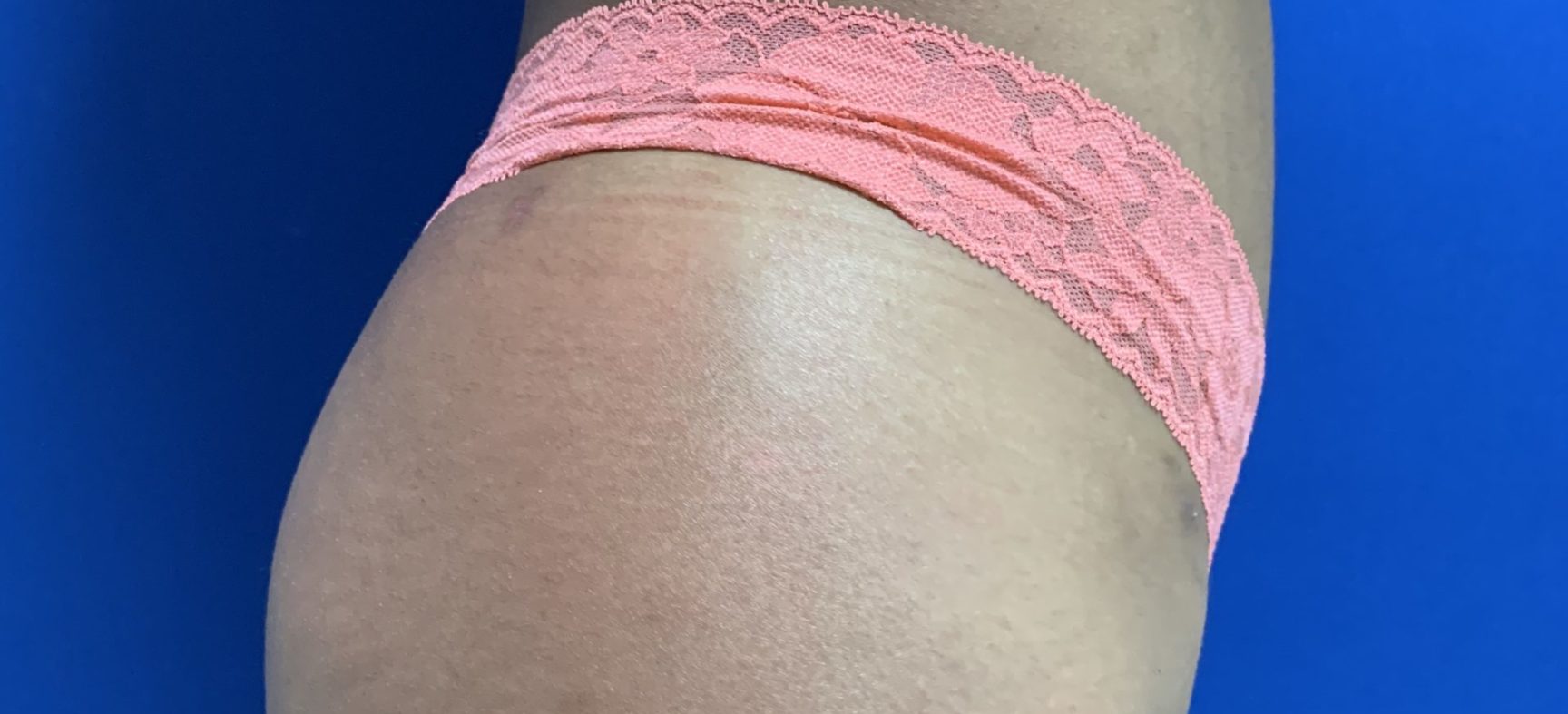 Buttock lift- BBL is not a true lift but.....
