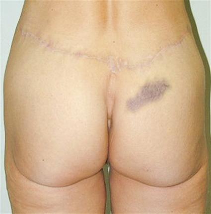 Buttock lift- as a part of lower body (circumferential) body lift
