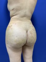 Buttock lift- is BBL a true lift?