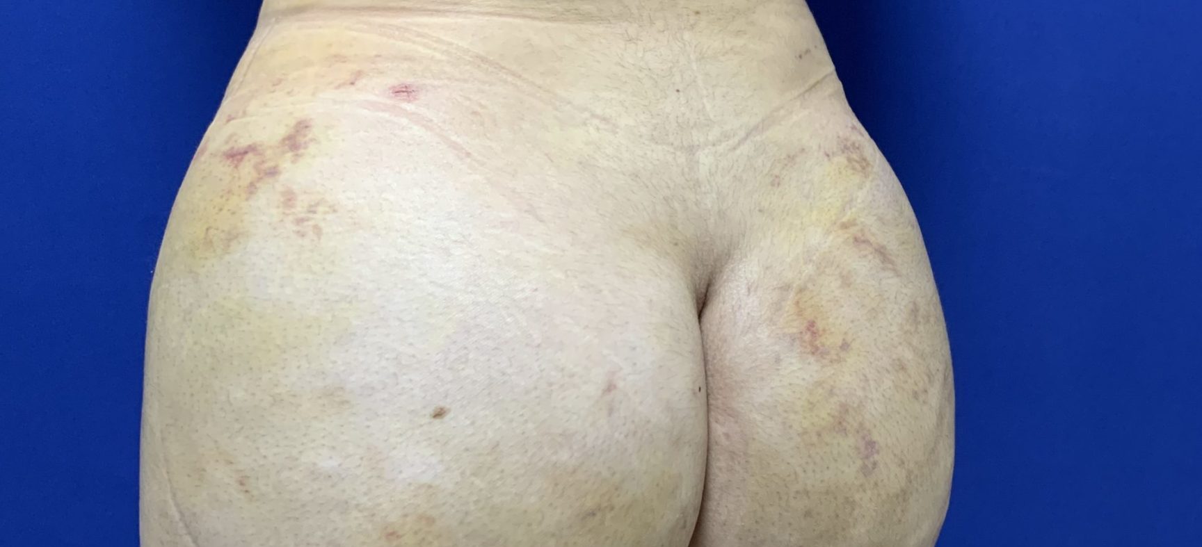 Buttock lift- is BBL a true lift?