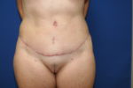 Tummy tuck-abdominoplasty