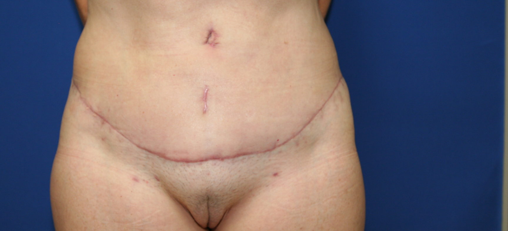 Tummy tuck-abdominoplasty