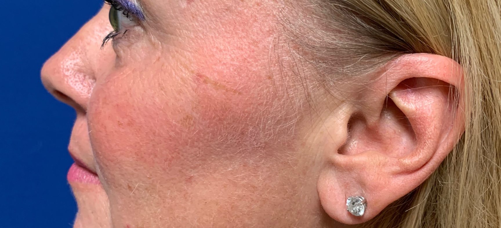 Face and neck lift