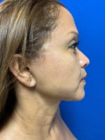 Face and neck lift