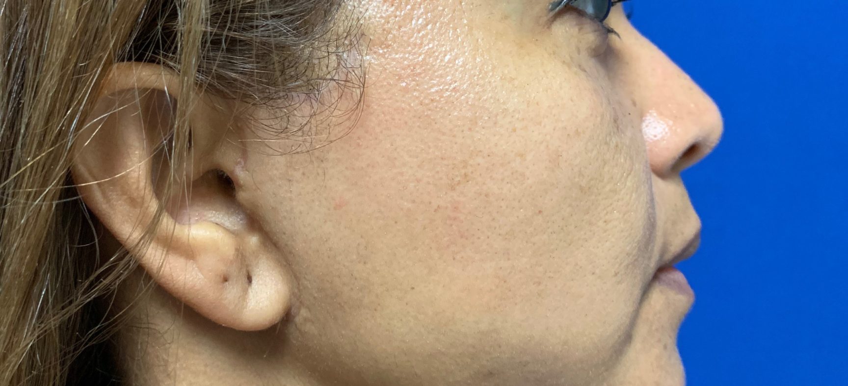 Face and neck lift
