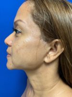 Facial fat grafts