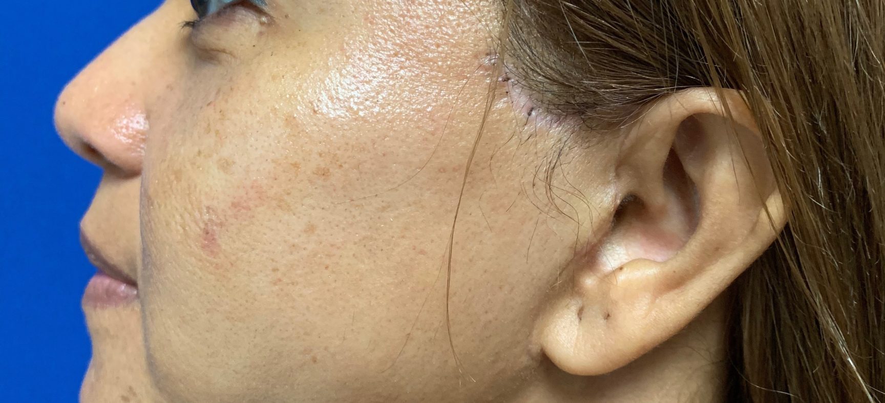 Facial fat grafts