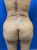 Brazilian Butt Lift- BBL