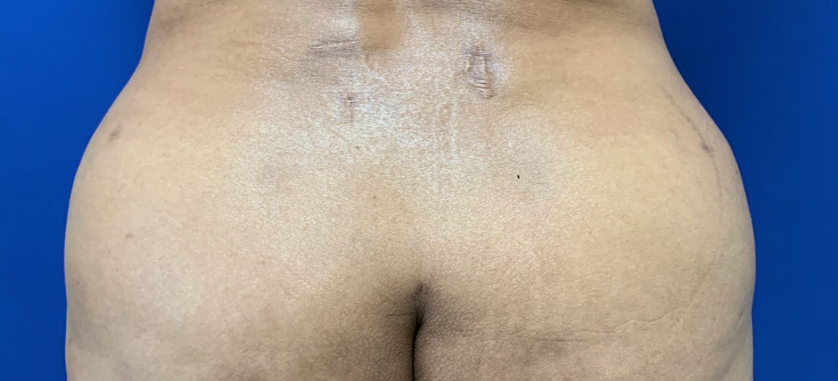 Brazilian Butt Lift- BBL