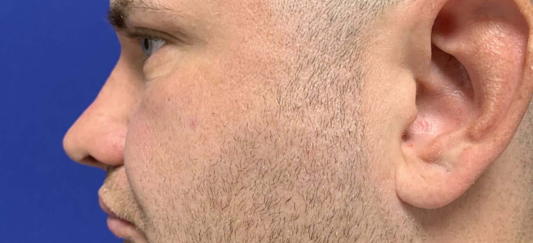 Facial chin implant