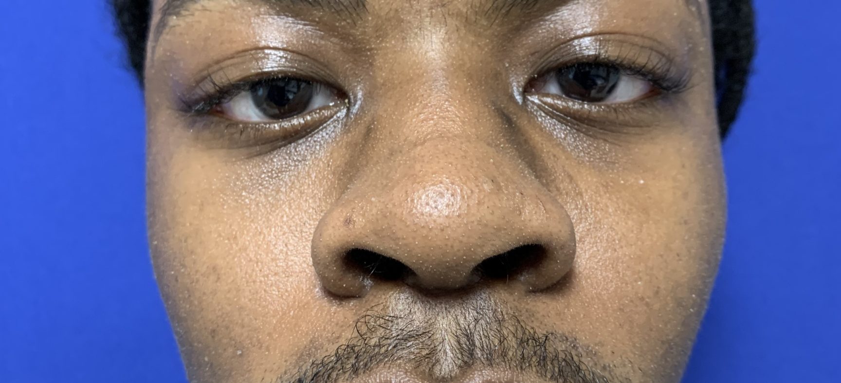 Facial, cheek implants