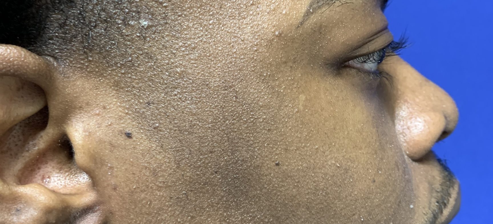 Facial, cheek implants