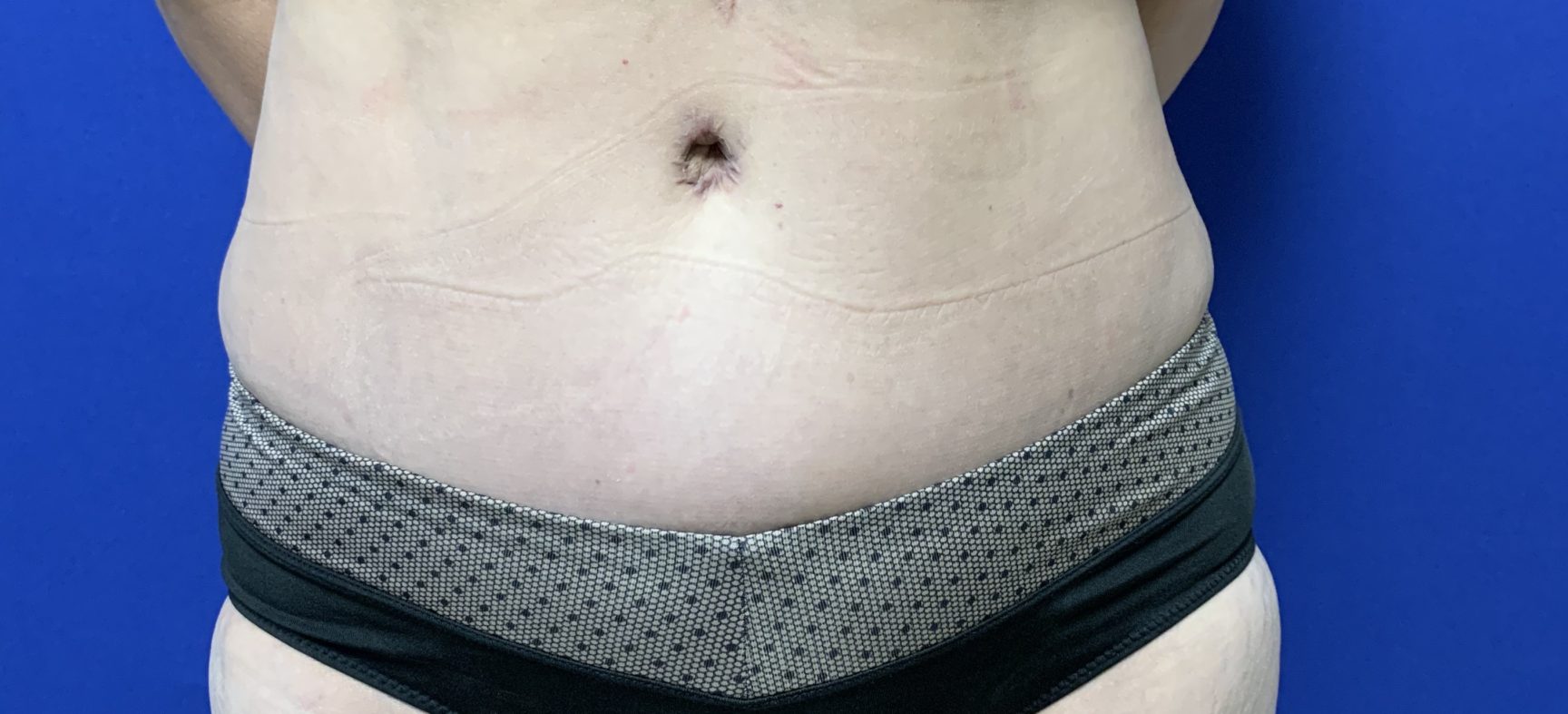 Tummy tuck-Abdominoplasty