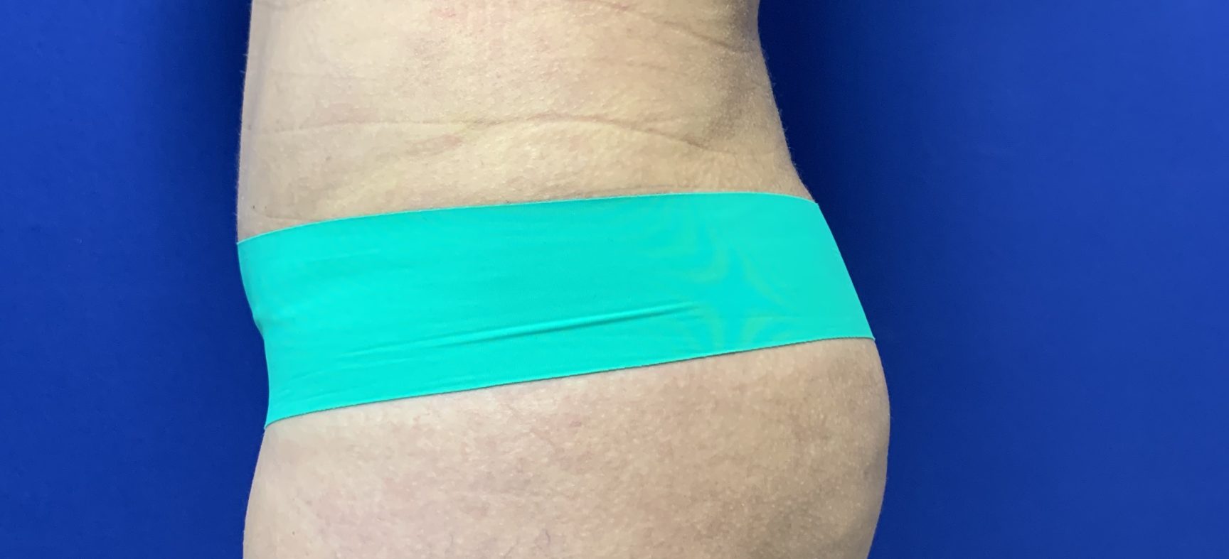 Brazilian Butt Lift- BBL