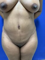 Tummy Tuck-Abdominoplasty