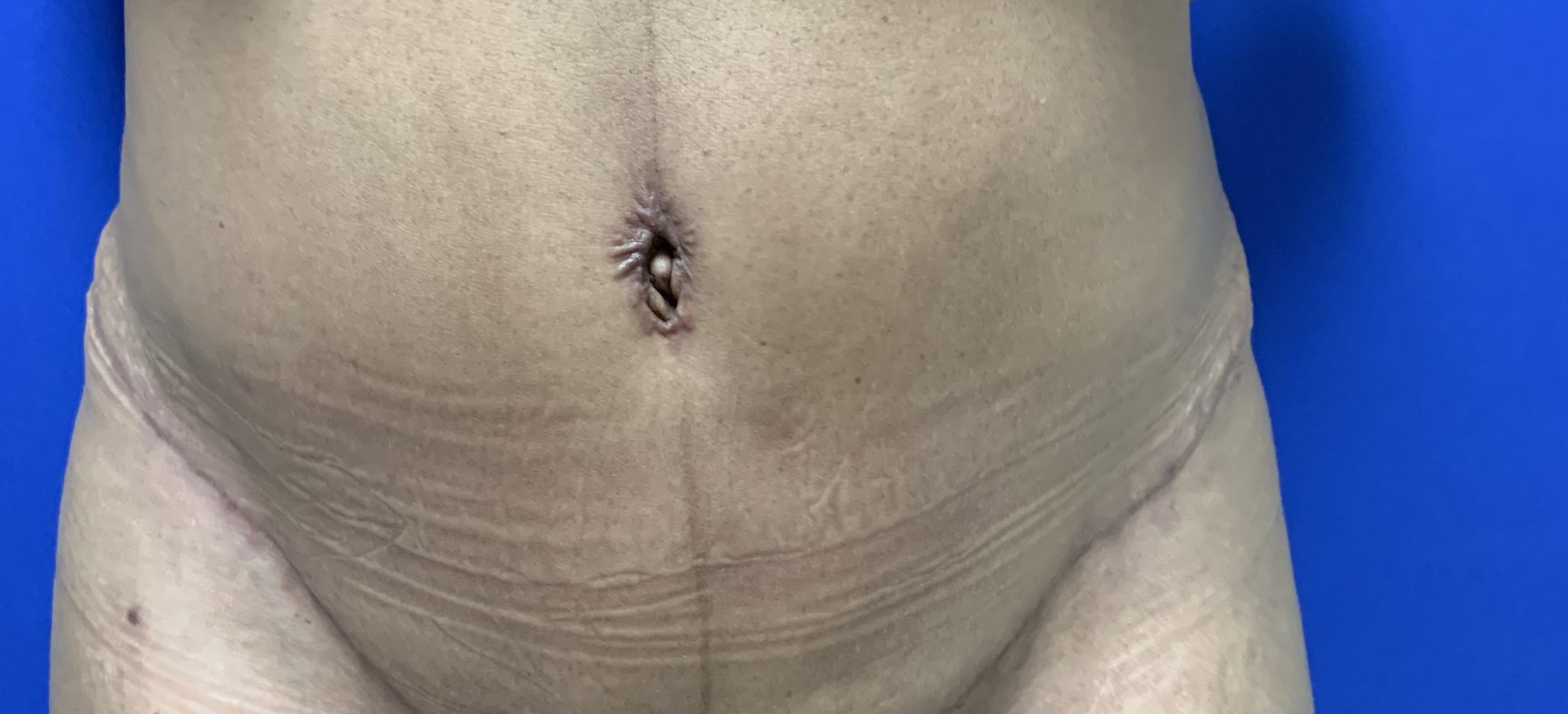 Tummy Tuck-Abdominoplasty