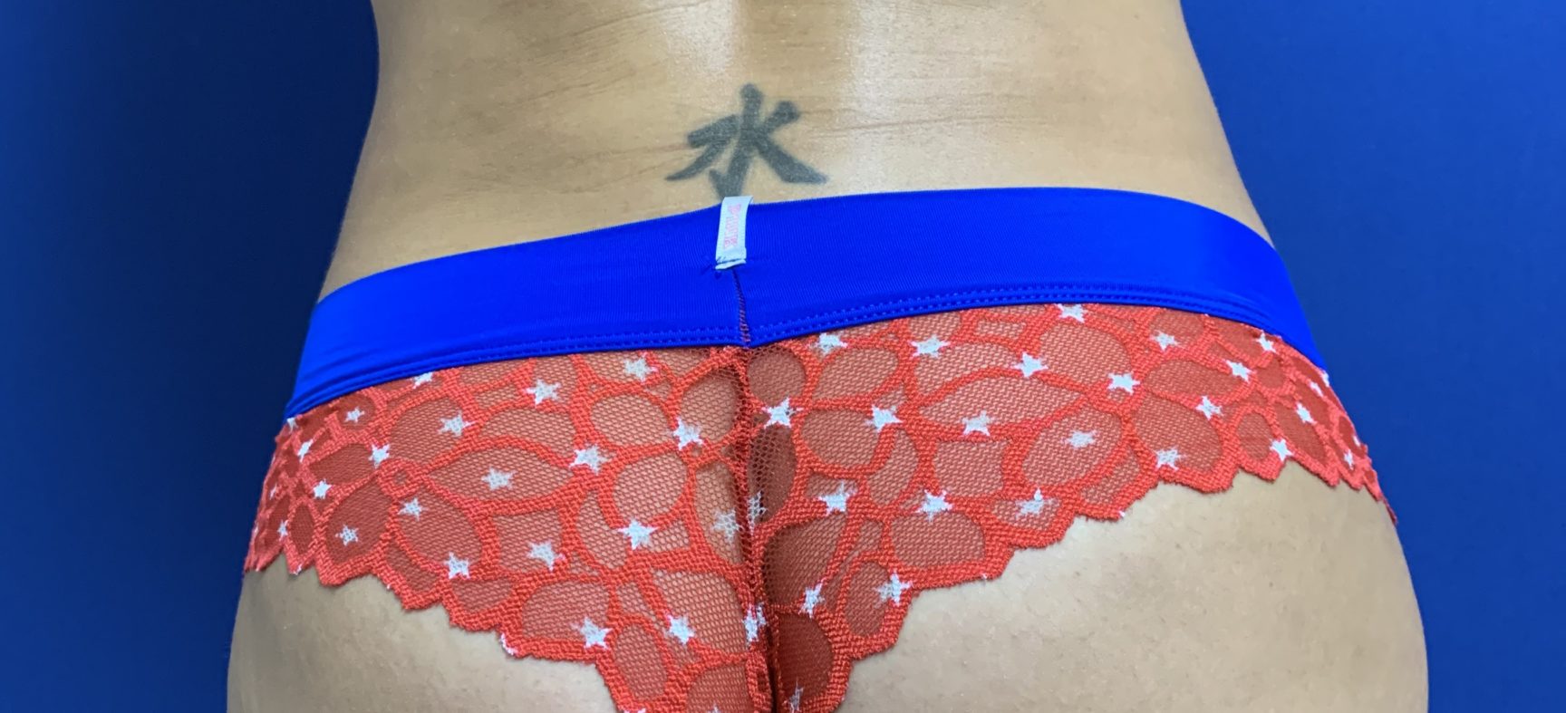 Brazilian Butt Lift- BBL