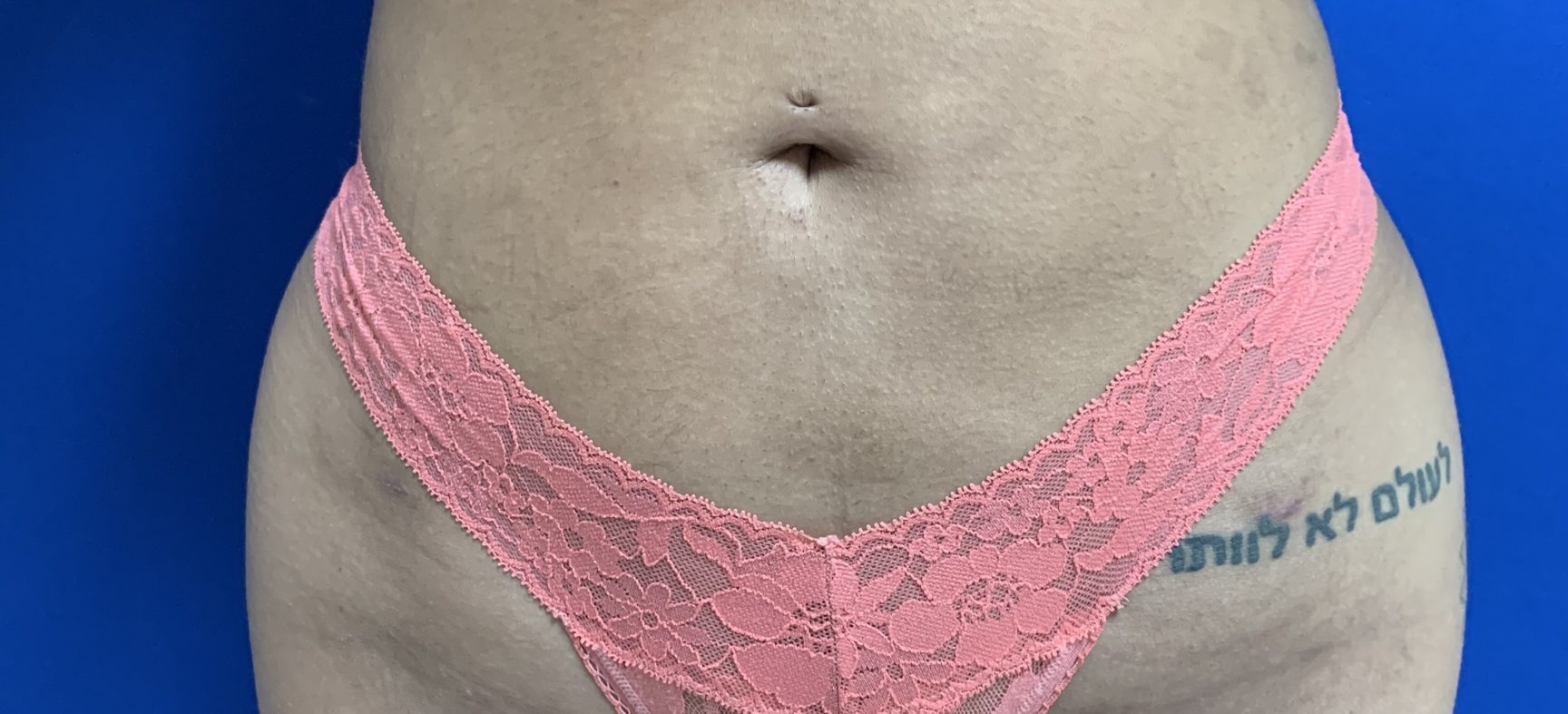 Liposuction